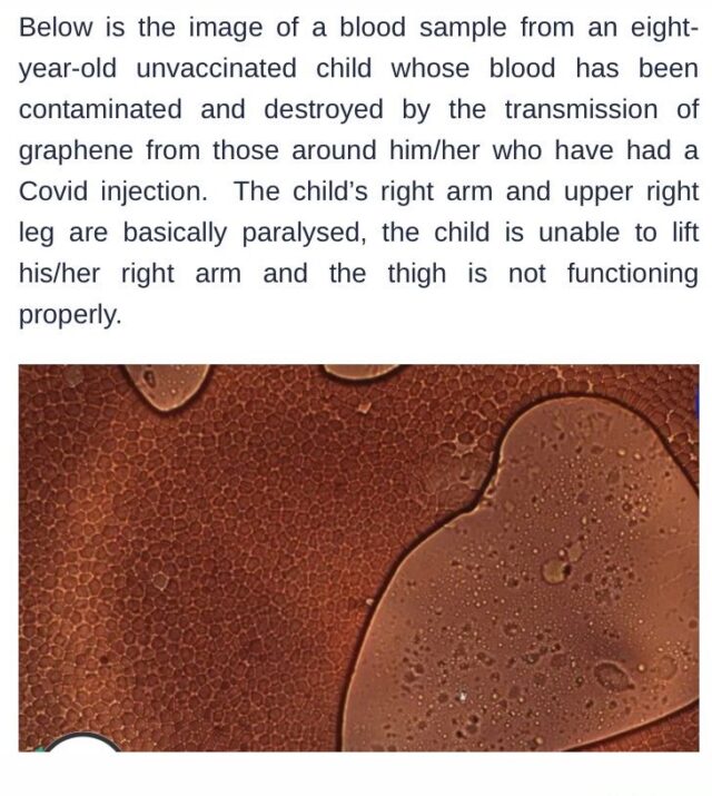 8_Year_old_unvaccinated_child_blood_damage