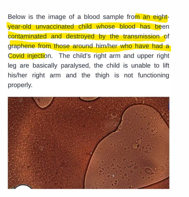 unvaccinated_child_with_graphene_damage